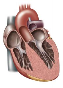 Сердце с гипертрофической кардиомиопатией