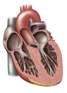 Сердце с обструктивной гипертрофической кардиомиопатией